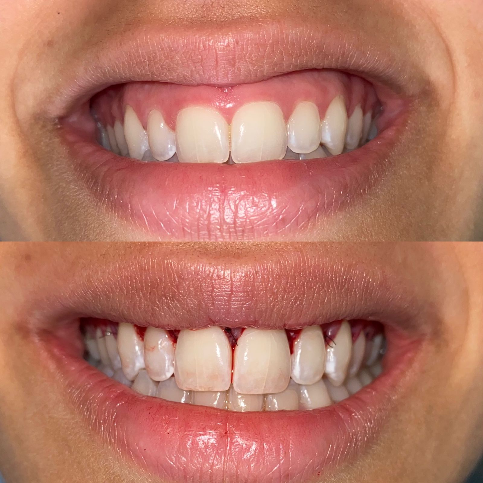 Alimentação Ideal Durante a Cicatrização da Gengivoplastia