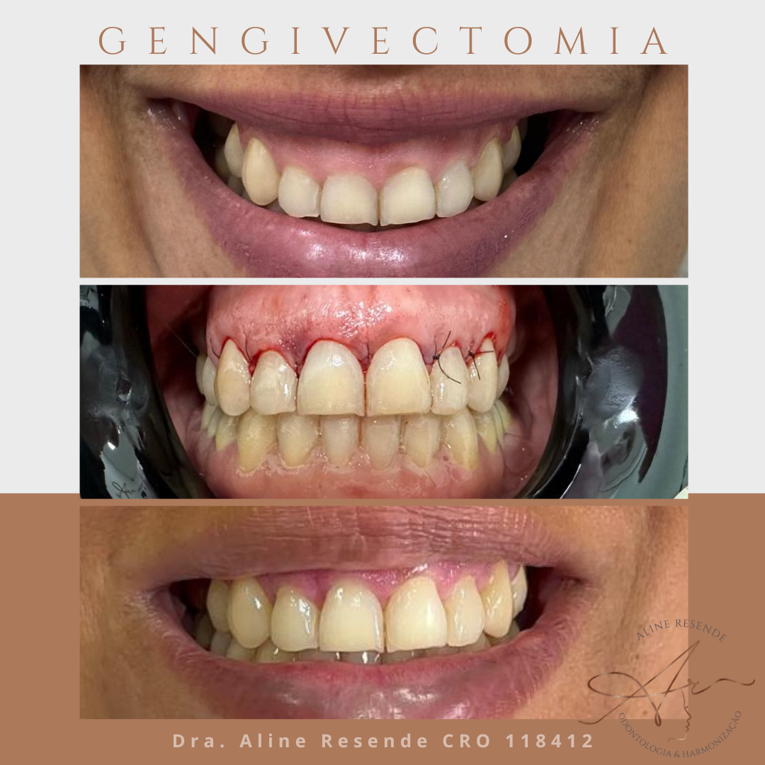 O que é Gengivoplastia e Para Quem é Indicada?