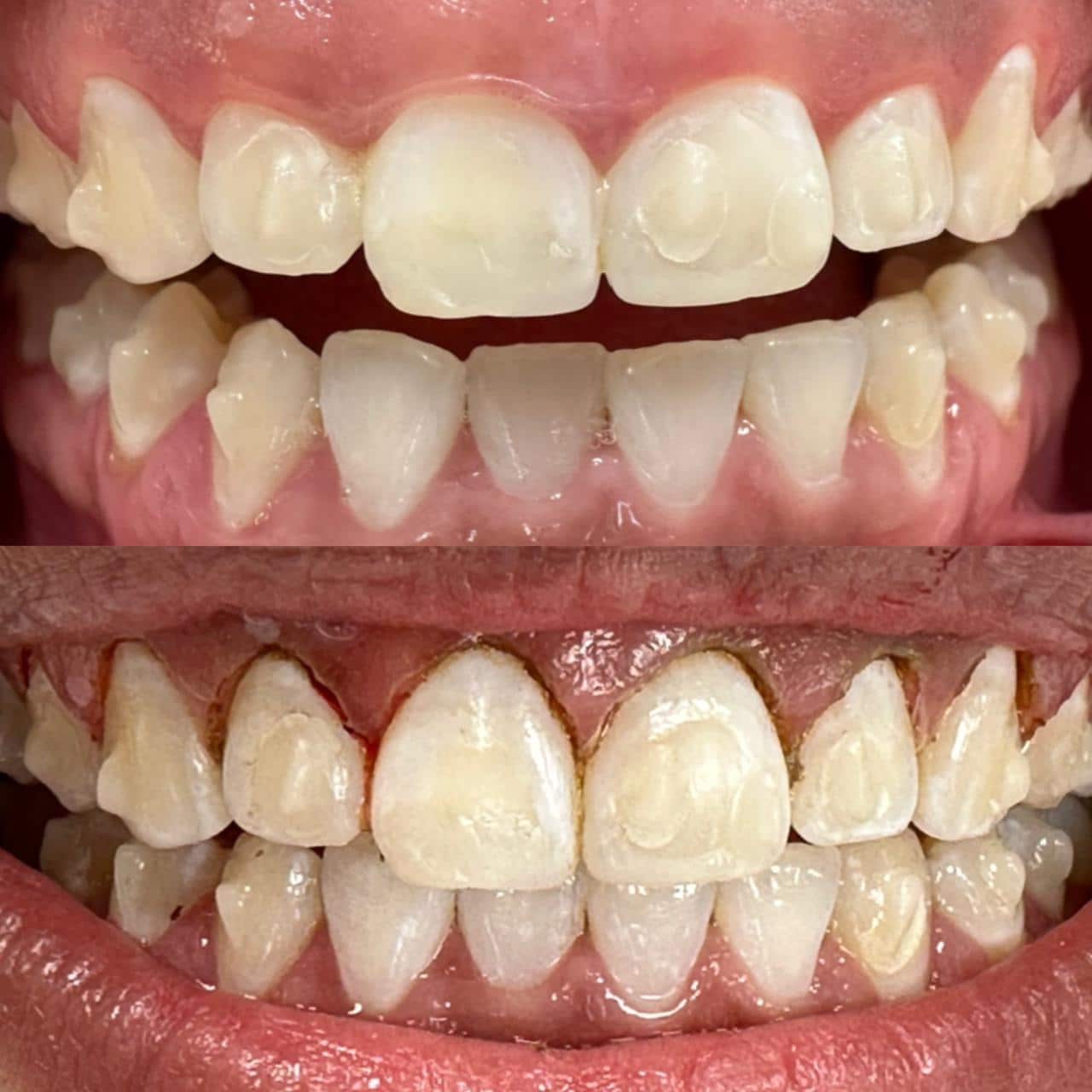 Guia Completo de Cuidados Pós-Operatórios da Gengivoplastia