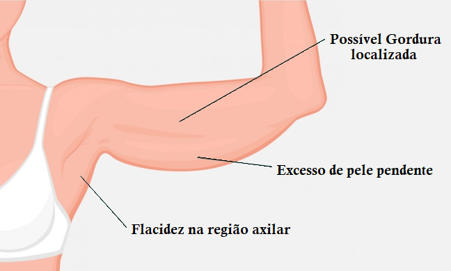 Como Diferenciar Gordura de Mama Acessória na Axila