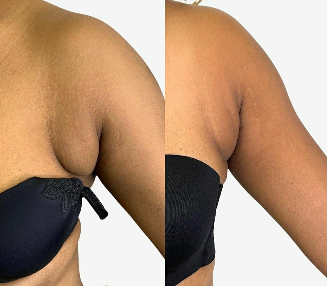 gordura embaixo do braço