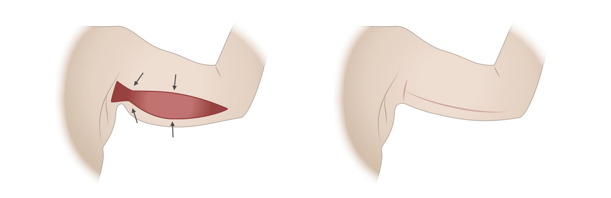 Lipoaspiração Axilar: Indicações e Recuperação
