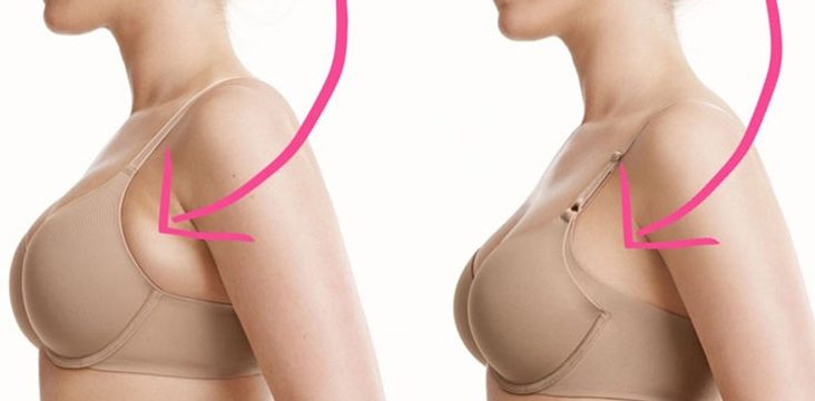 Mama Acessória: Guia Completo sobre Diagnóstico e Tratamento