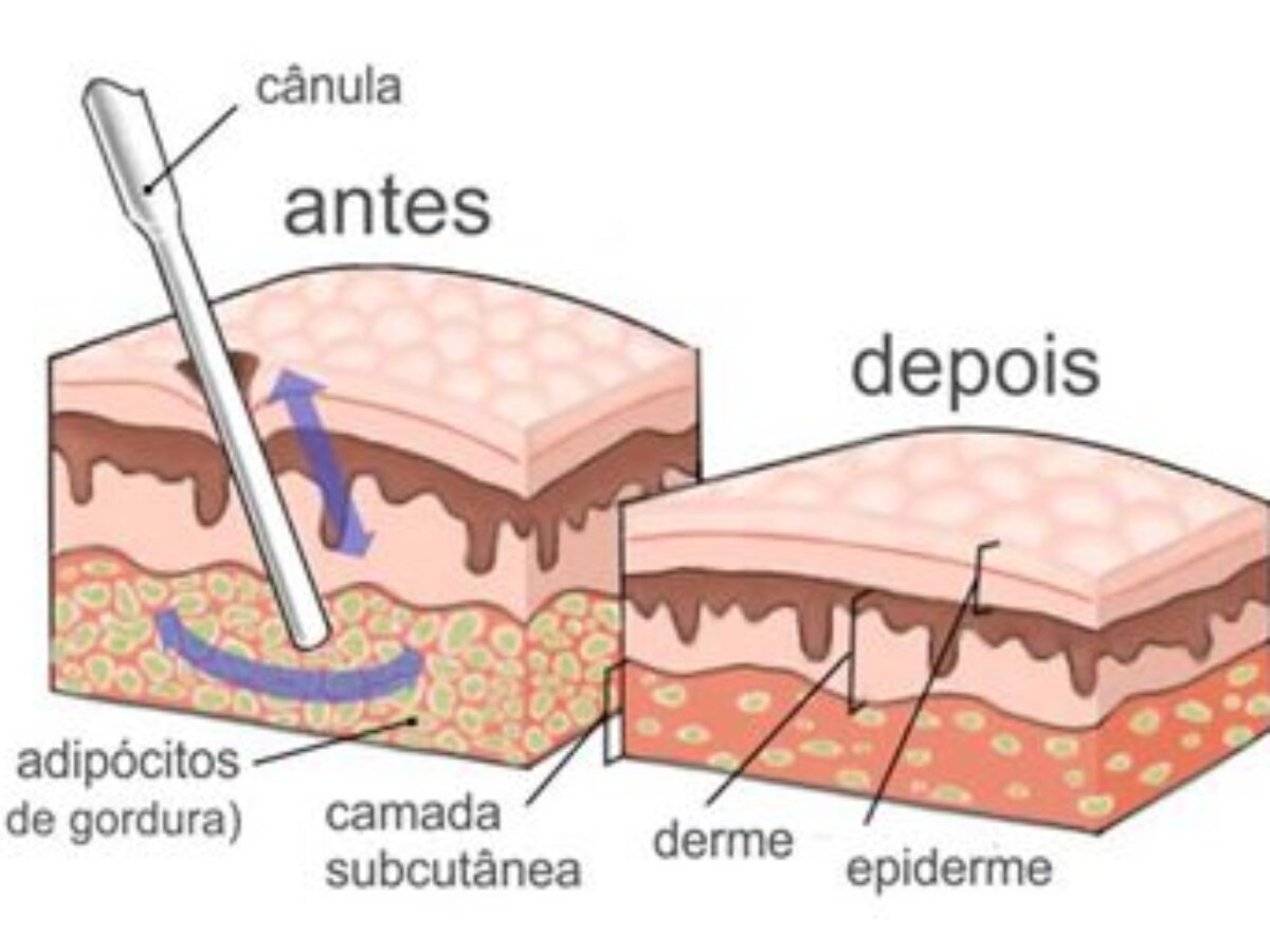Procedimentos Estéticos Não Invasivos para o 