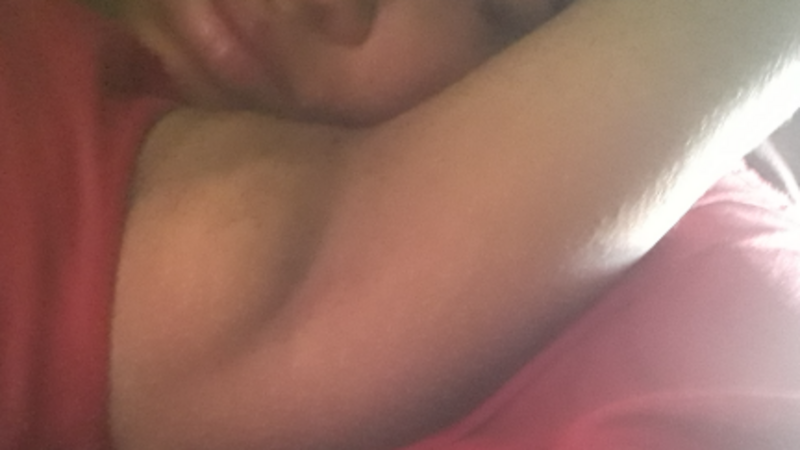 Lipoaspiração Axilar: Indicações e Recuperação