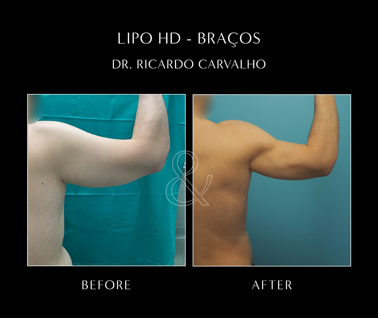 Lipoaspiração Axilar: Indicações e Recuperação