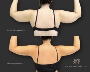 Exercícios Eficazes para Reduzir a Gordura nas Axilas