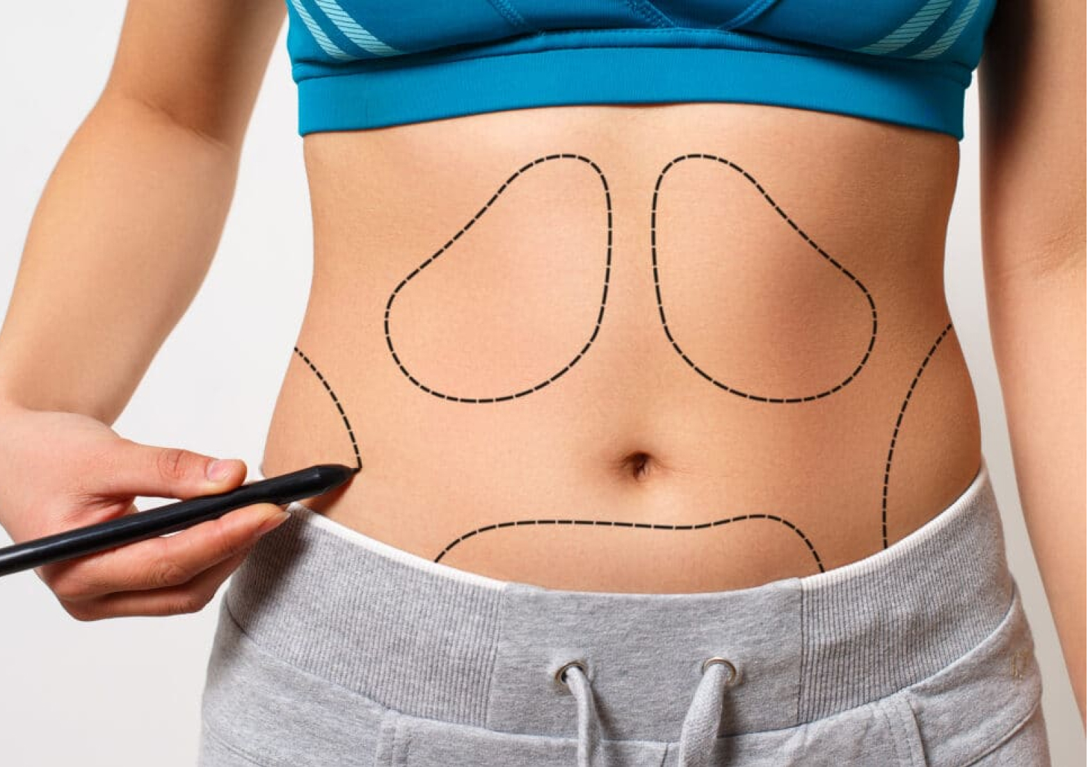 gordura humana lipoaspiração