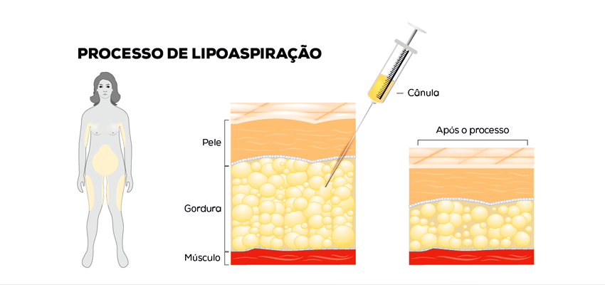 Normas da ANVISA para Descarte de Resíduos de Lipoaspiração