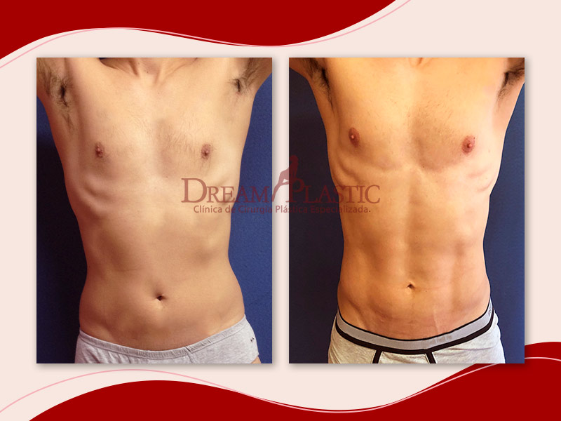 Mitos e Verdades sobre a Gordura que Volta Após a Lipoaspiração