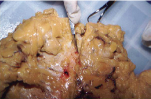 Lipoaspiração Segura: Entenda os Limites de Volume Retirado
