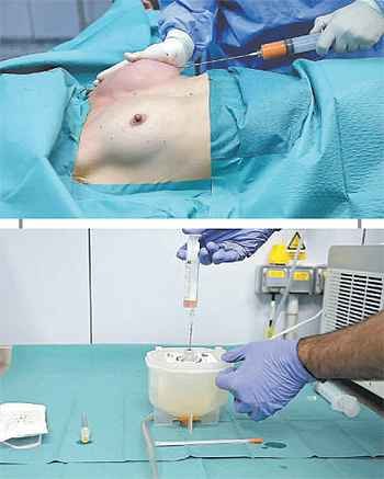 Mitos e Verdades sobre a Gordura que Volta Após a Lipoaspiração