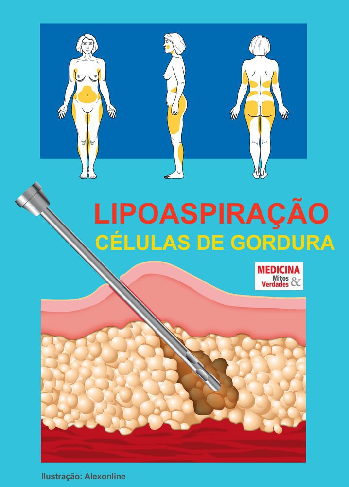 Lipoaspiração Segura: Entenda os Limites de Volume Retirado
