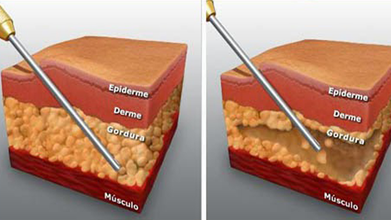 O Processo de Purificação da Gordura para Lipoenxertia
