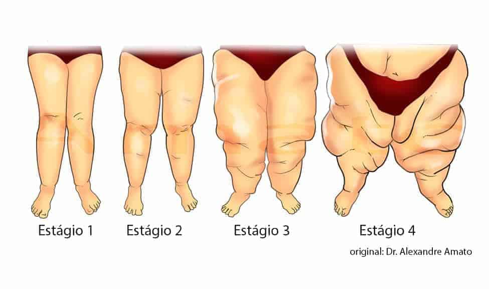 gordura humana lipoaspiração