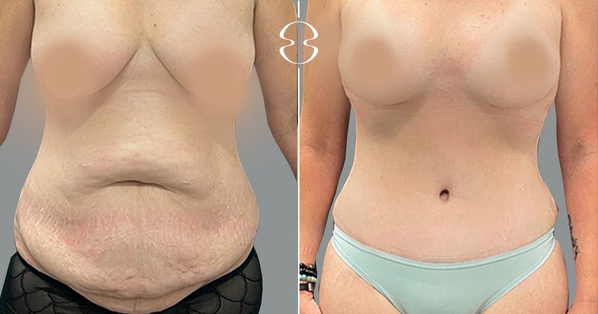 Lipoenxertia: Guia Completo para Aumento de Glúteos e Mamas