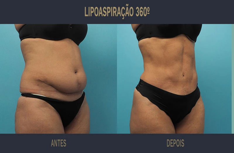Normas da ANVISA para Descarte de Resíduos de Lipoaspiração