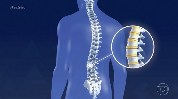 Síndrome da Cauda Equina: Um Sinal de Alerta para a Hérnia de Disco