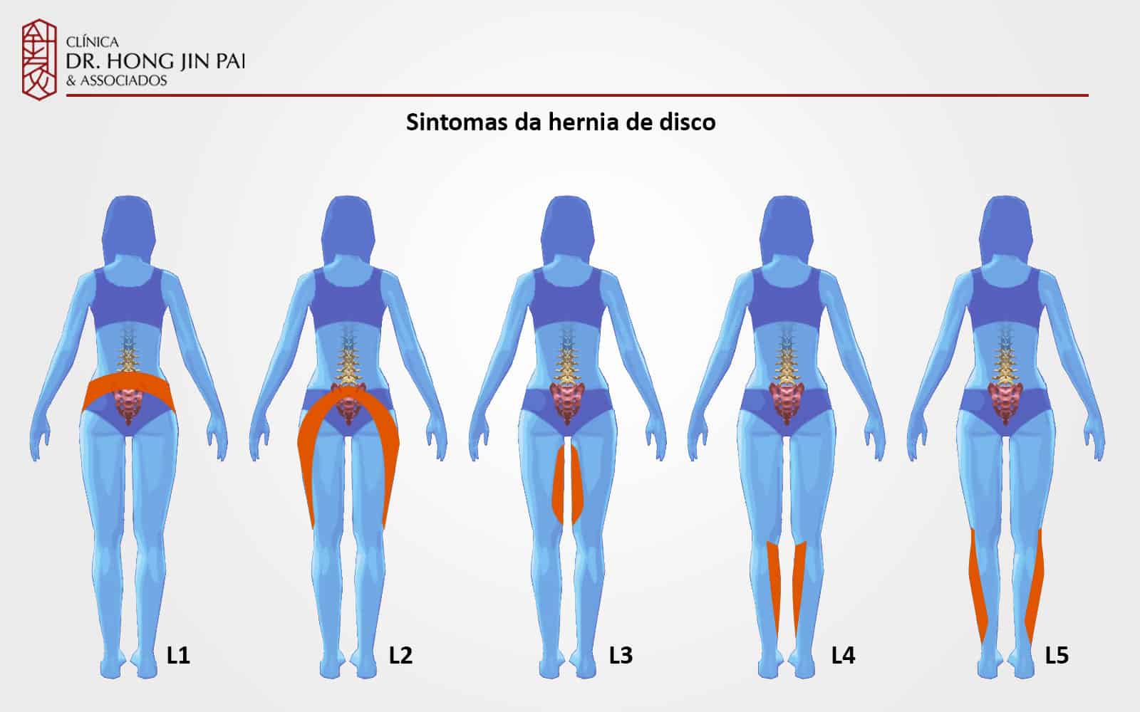 Hérnia de Disco: Guia Completo de Sintomas e Tratamentos