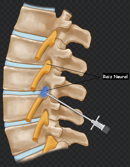 Prevenindo a Recidiva da Hérnia de Disco: Dicas Essenciais