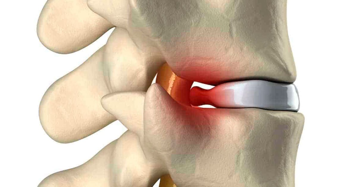 hernia de disco tem cura