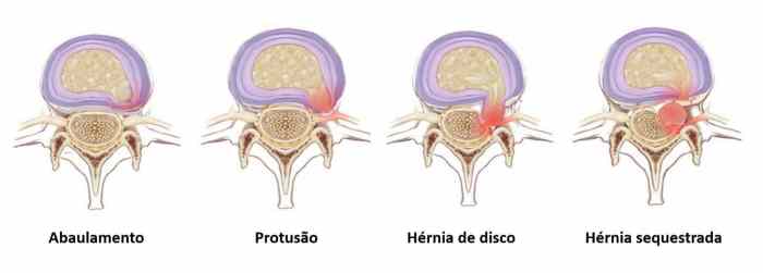Hérnia de Disco: Guia Completo de Sintomas e Tratamentos