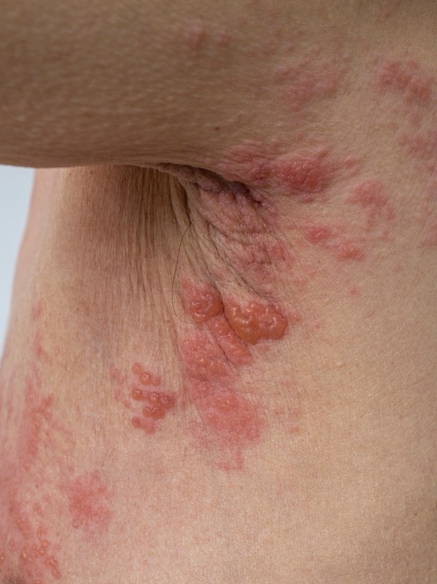 Guia Completo de Tratamento para Herpes Simples