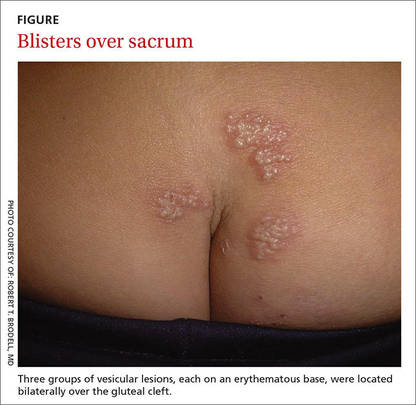 Guia Completo de Tratamento para Herpes Simples