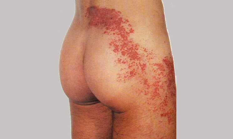 A Importância da Consulta Médica para Lesões Virais na Pele