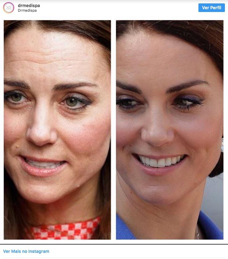 5 ideias de títulos:
1. A Transformação de Kate Middleton: Do Estilo Casual à Elegância Real
2. Cabelo de Kate Middleton: A Camaleoa que Surpreendeu o Público
3. O Impacto do Câncer na Saúde e Aparência de Kate Middleton
4. Vida Pessoal de Kate Middleton: Antes e Depois da Família Real
5. Kate Middleton: Uma Análise Detalhada de sua Evolução Estilística e Pessoal