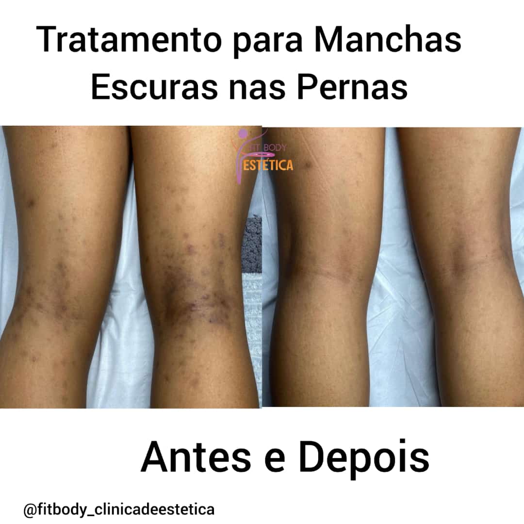 manchas escuras nas pernas fotos