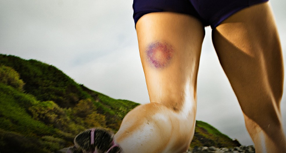 Dermatite Ocre: Entenda as Causas e Tratamentos