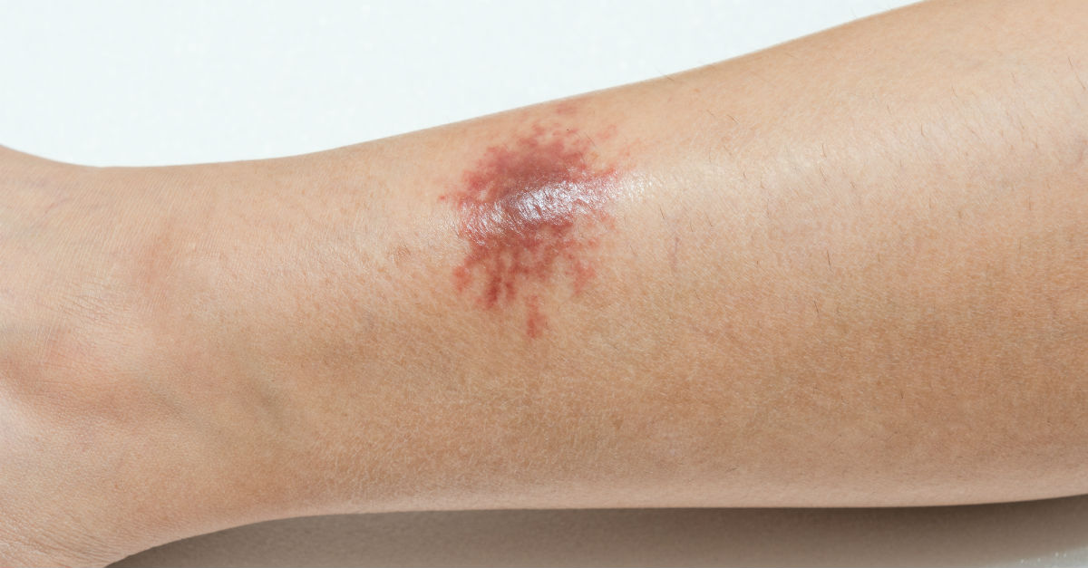 Hiperpigmentação Pós-Inflamatória: Soluções para Marcas na Pele