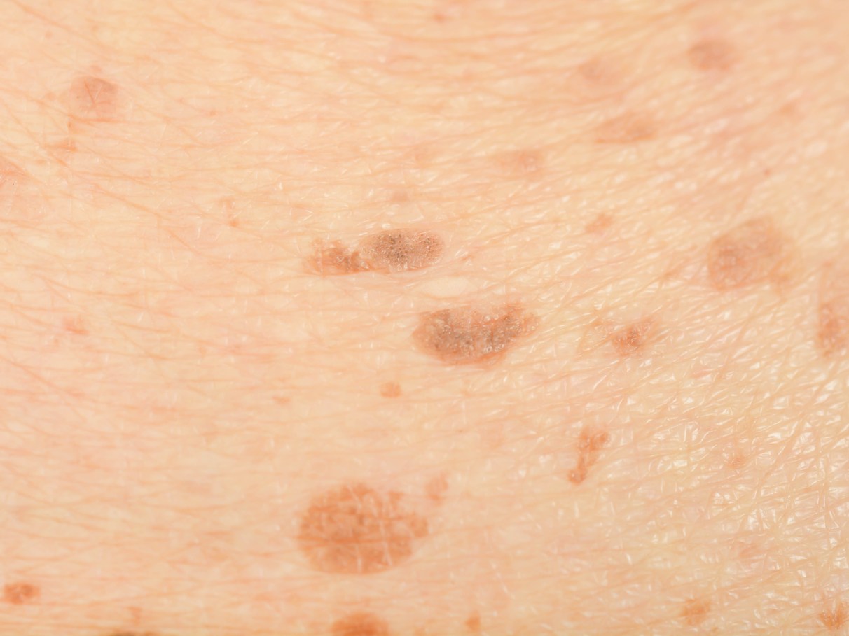 manchas escuras nas pernas fotos