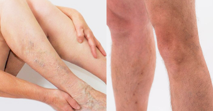 Manchas nas Pernas: Quando Procurar um Dermatologista?