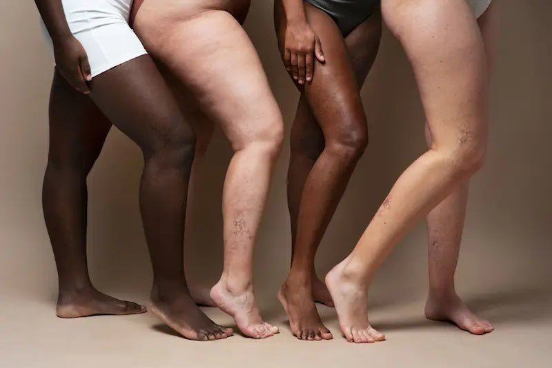 Hiperpigmentação Pós-Inflamatória: Soluções para Marcas na Pele