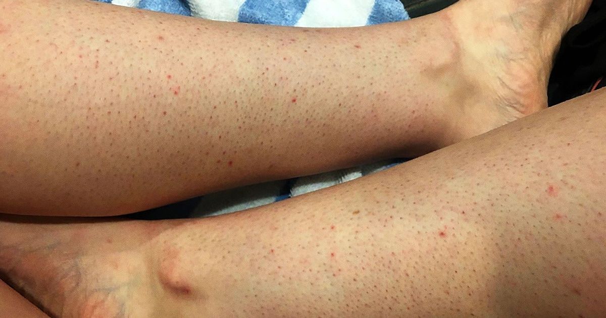 Acantose Nigricans: Identificando e Gerenciando Condições de Pele