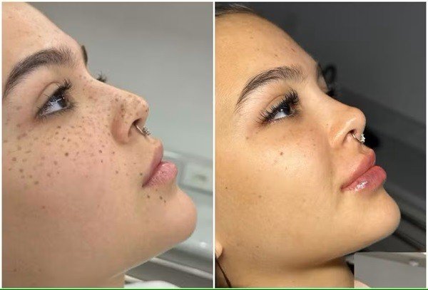 mel no rosto antes e depois fotos