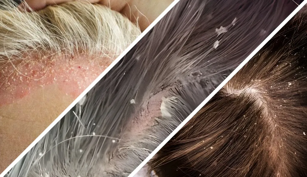 Fatores Climáticos e a Piora da Caspa: O Que Você Precisa Saber