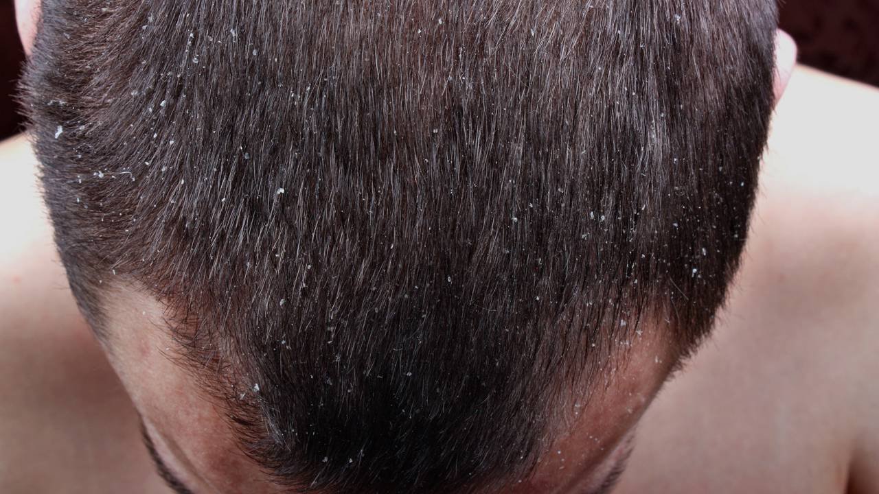 Entendendo a Dermatite Seborreica: Causas, Sintomas e Tratamentos