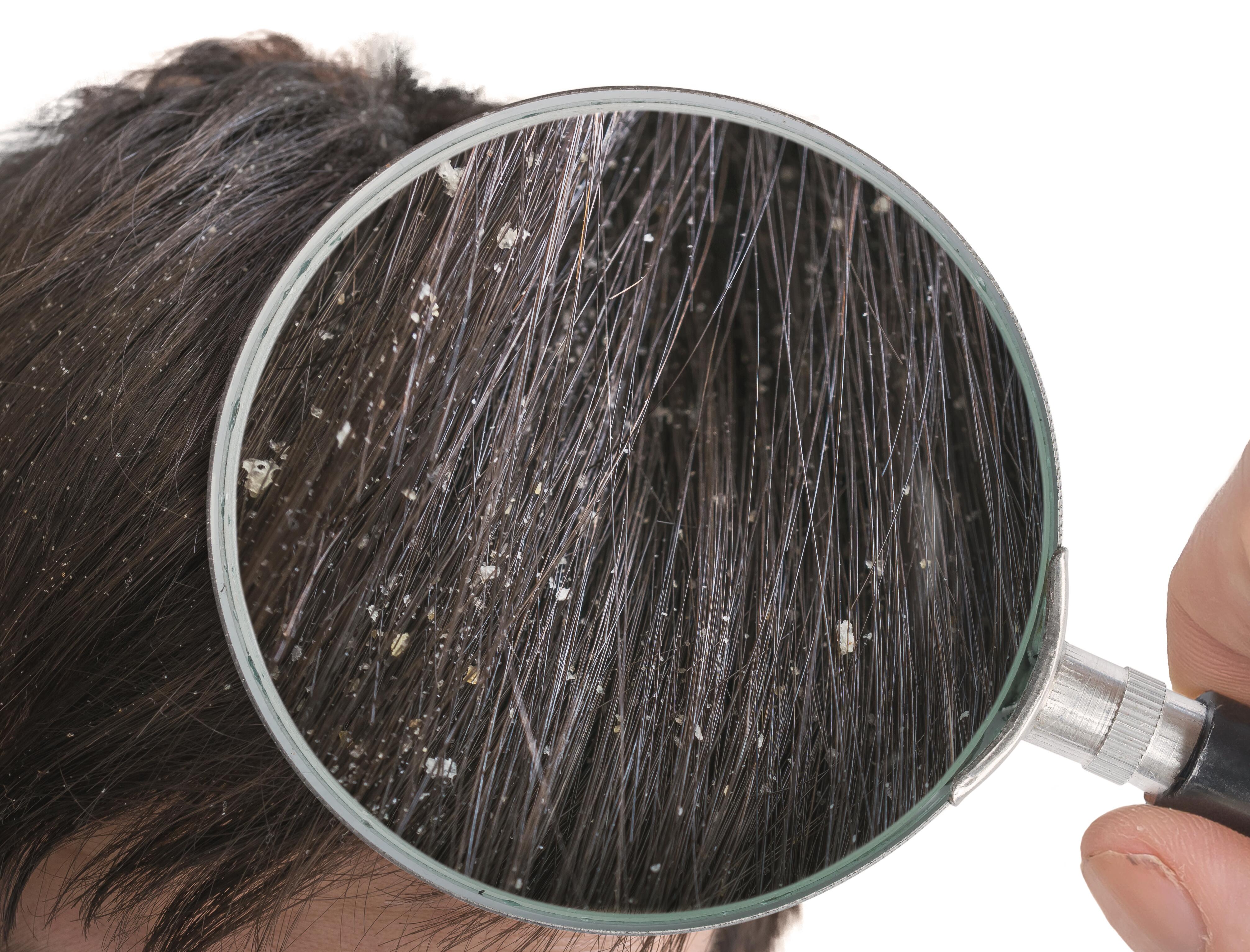 Fatores Climáticos e a Piora da Caspa: O Que Você Precisa Saber