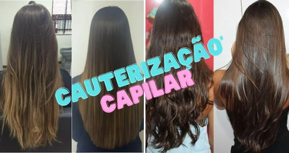 Tratamento de verrugas com cauterização