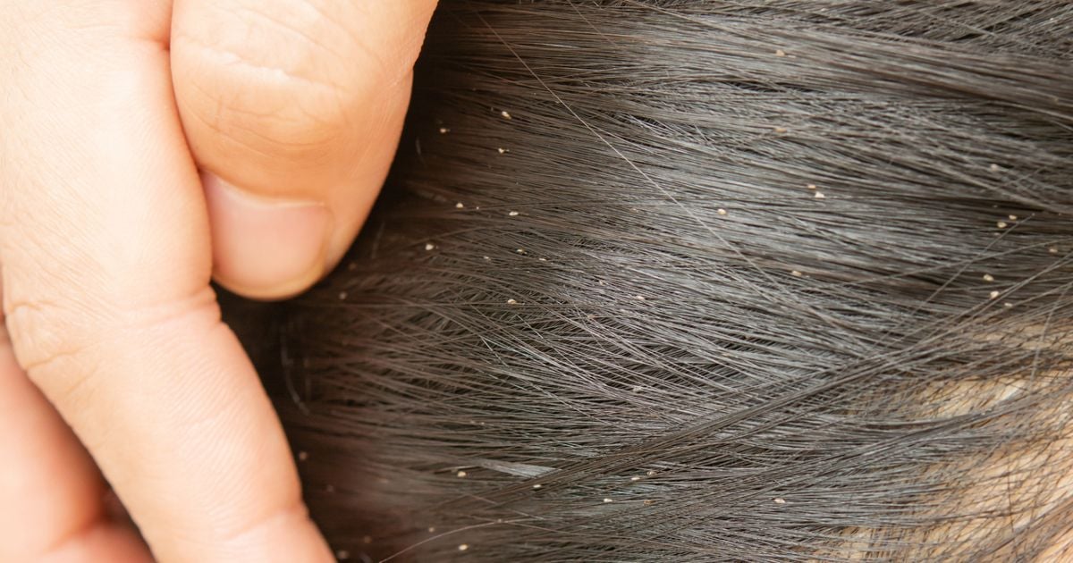 Sonhar com Piolho na Cabeça de Outra Pessoa: Entenda os Sinais