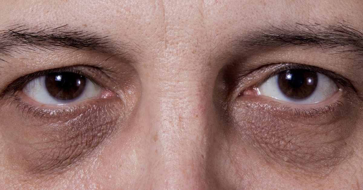 Dermocosméticos para Olheiras: Os Melhores Ativos (Vitamina C, Retinol, Niacinamida)