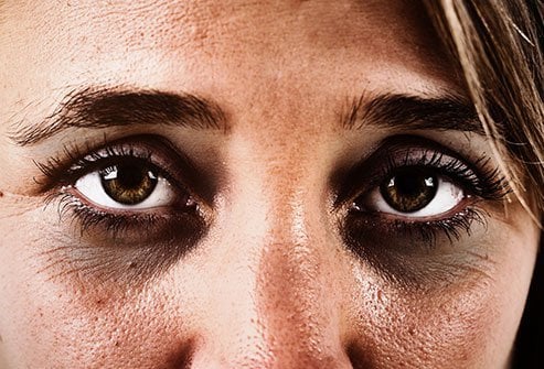 A Conexão entre Rinite, Anemia e Olheiras: Entenda e Previna