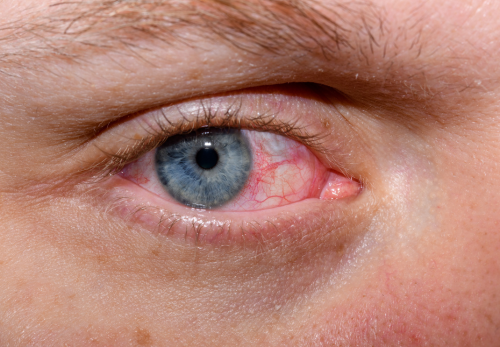 Guia Completo: Como Identificar e Tratar a Síndrome do Olho Seco; Olho Seco e Telas: Entenda a Conexão e Previna-se; Alívio Imediato para Olhos Secos: Dicas e Tratamentos Eficazes; Doenças Autoimunes e Olho Seco: O Que Você Precisa Saber; Lágrimas Artificiais e Higiene Palpebral: Soluções para o Olho Seco