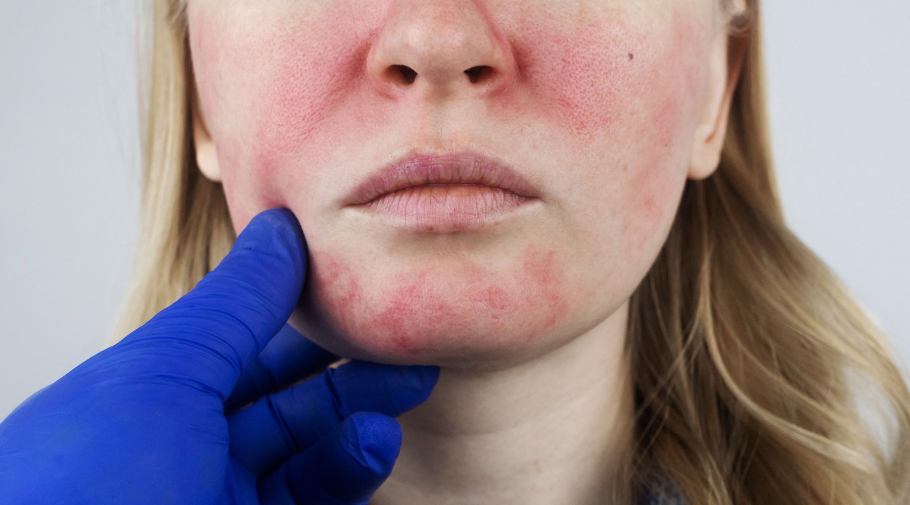 Guia completo sobre Dermatite Atópica