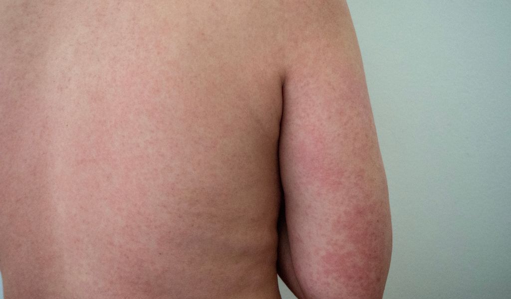 Como identificar e tratar Rosácea