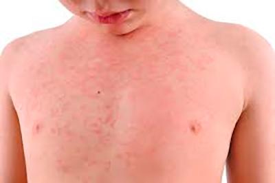 Cuidados essenciais para pele irritada