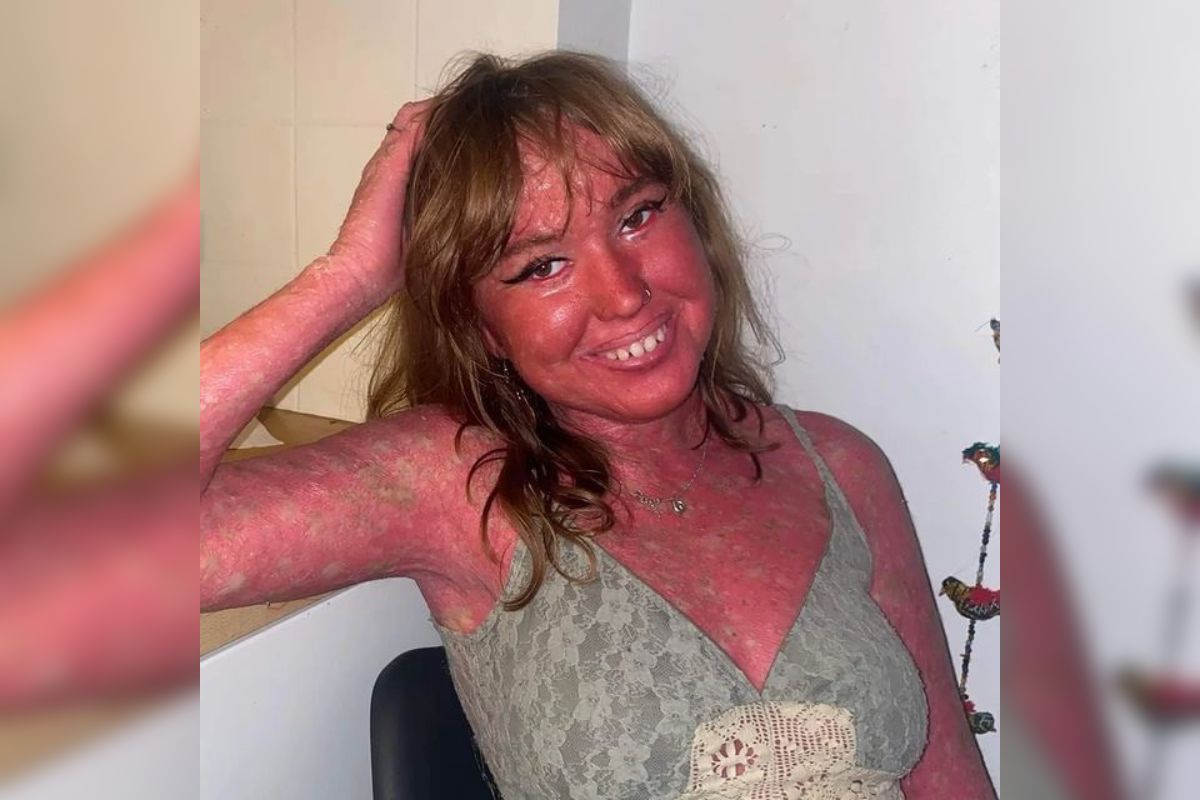 Como identificar e tratar Rosácea